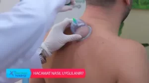 Sağlık Mutluluk DemektirHacamat Tedavisi Hacamat nasıl uygulanır? Dr. Turgay ÇINAR