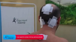 Sağlık Mutluluk DemektirHacamat Tedavisinin Faydaları Nedir? Dr. Turgay ÇINAR