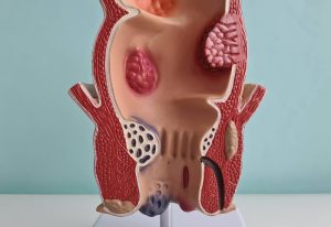 Hemoroid