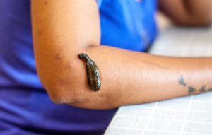 Sülük Hangi Hastalıklarda Kullanılır?