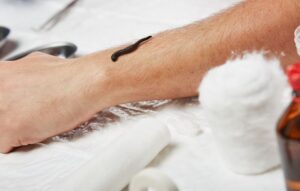 Sülük Tedavisi İle İlgili Haber ve Videolar