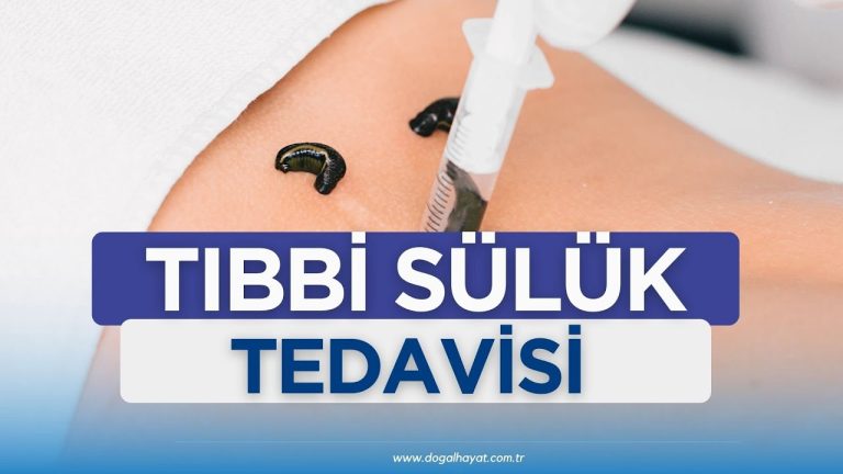 Sülükten sonra ne zaman banyo yapılır?